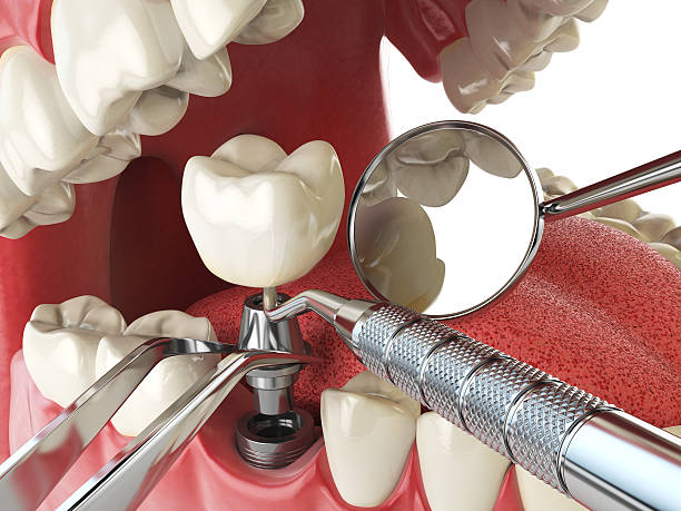 Best Emergency Dentist for Lost Fillings or Crowns in Sunnyside, CA